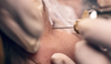 Plasma fibroblast skin tightening: the option without surgeries